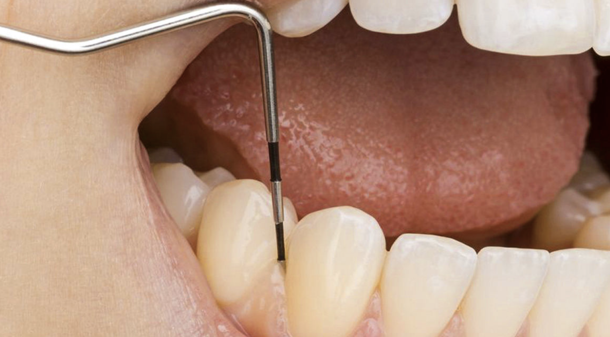 Periodoncia