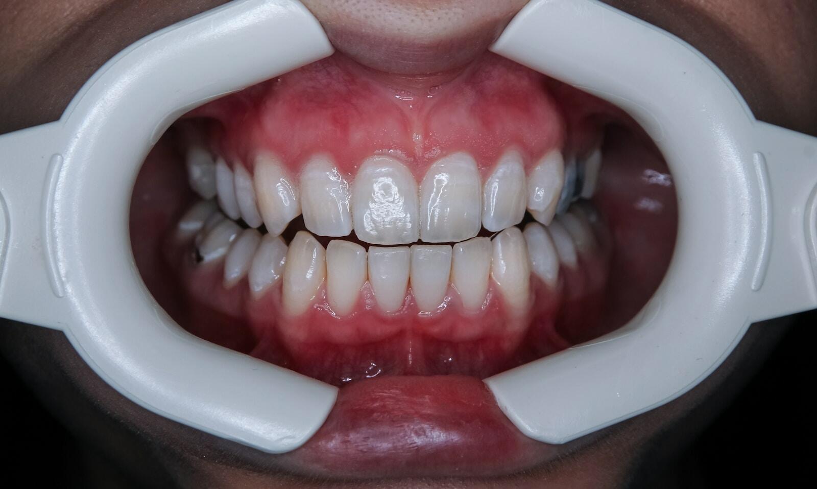 Injertos de encía y sonrisa gingival